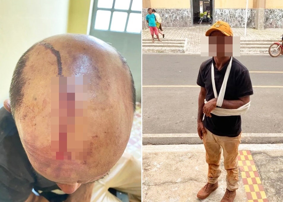 Homem é agredido a pedradas durante tentativa de assalto em Barras